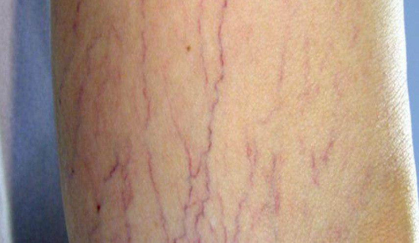 علاج فعال للتخفيف من دوالي الساقين