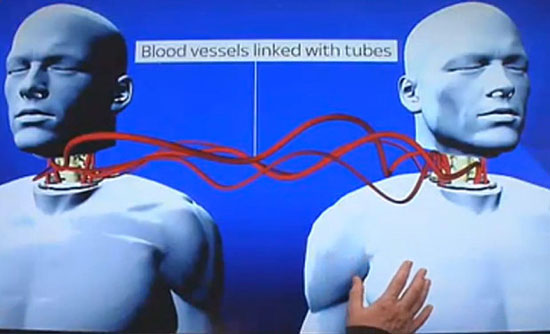 أول عملية "زراعة رأس" بالعالم تجري لمتبرع صيني !