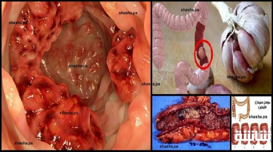 ليس مستحيلاً.. هذه الخطوات البسيطة تقيك من سرطان القولون
