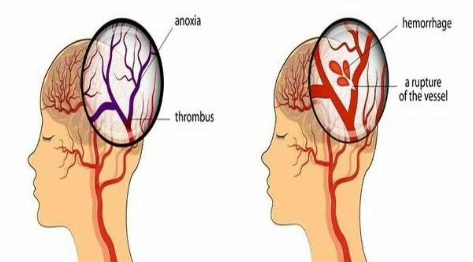 6 إشارات تنذركم بأن جلطة دماغية على وشك الحدوث