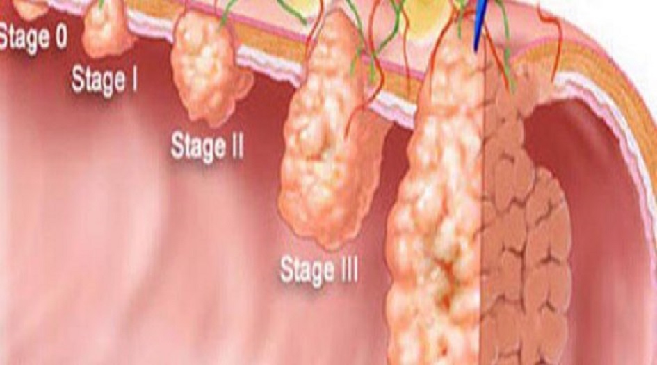 السرطان يموت إذا تناولتم هذه الأطعمة.. عليكم بها فوراً