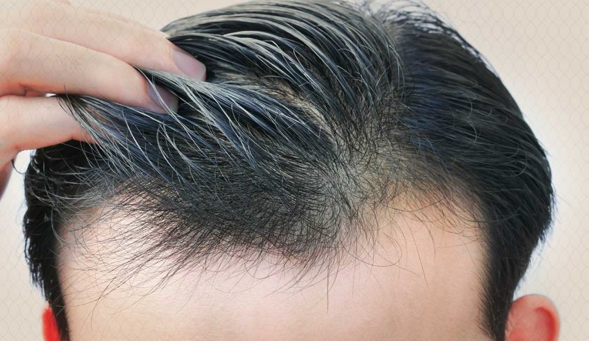 تقنية جديدة لمعالجة الصلع ونمو الشعر من جديد